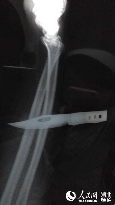 29岁小伙效仿网络视频 刀戳手指缝插伤自己