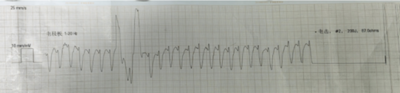 第一次电除颤后，心电图提示室速、患者无脉搏。