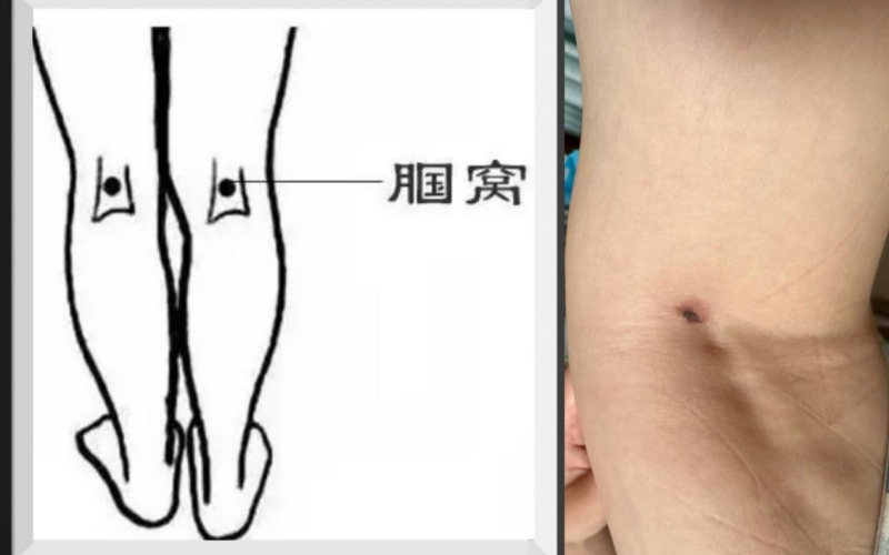 恙虫病東方體。